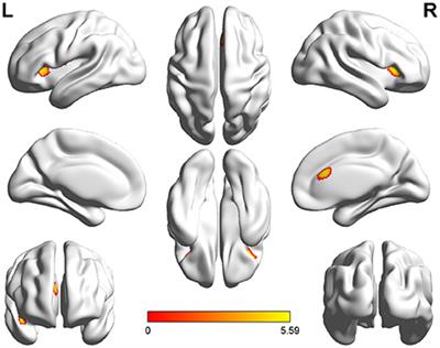 Brain Gray Matter Atrophy after Spinal Cord Injury: A Voxel-Based Morphometry Study
